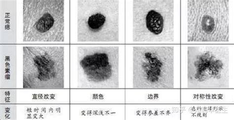 大痦子|你的痦子还“安分”吗？8种“异常”黑痣需尽快检查